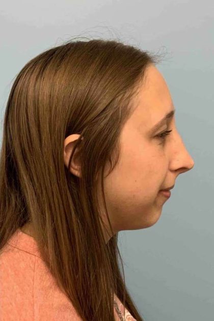 Nose Surgery Before & After Patient #11032