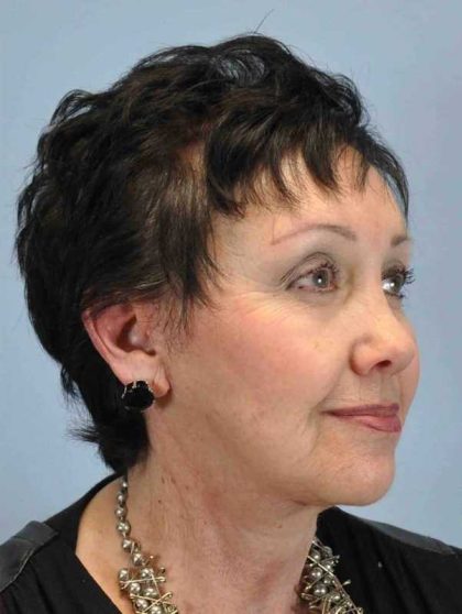 Neck Lift Before & After Patient #11039