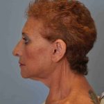 Neck Lift Before & After Patient #11046