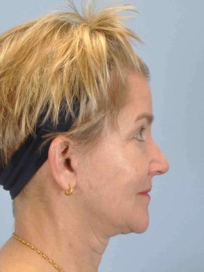 Neck Lift Before & After Patient #11076