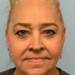 Neck Lift Before & After Patient #11083