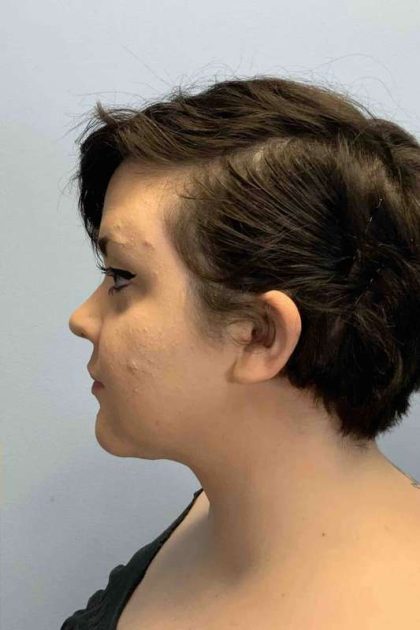 Neck Lift Before & After Patient #11120