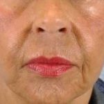 Lip Augmentation Before & After Patient #11148