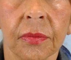 Lip Augmentation Before & After Patient #11148