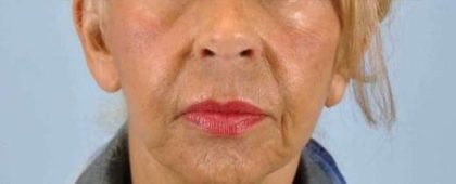 Lip Augmentation Before & After Patient #11148