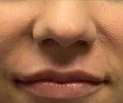Lip Augmentation Before & After Patient #11151