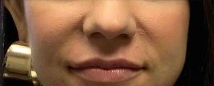 Lip Augmentation Before & After Patient #11151