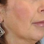 Lip Augmentation Before & After Patient #11163