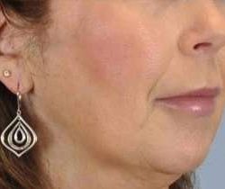Lip Augmentation Before & After Patient #11163