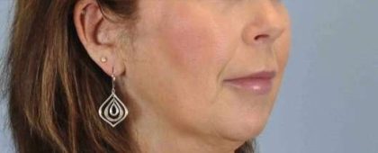 Lip Augmentation Before & After Patient #11163