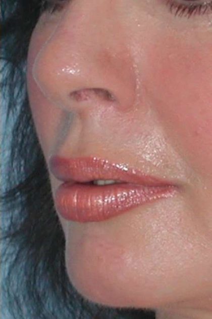 Lip Augmentation Before & After Patient #11175