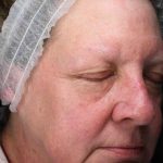 Laser Resurfacing Before & After Patient #11182