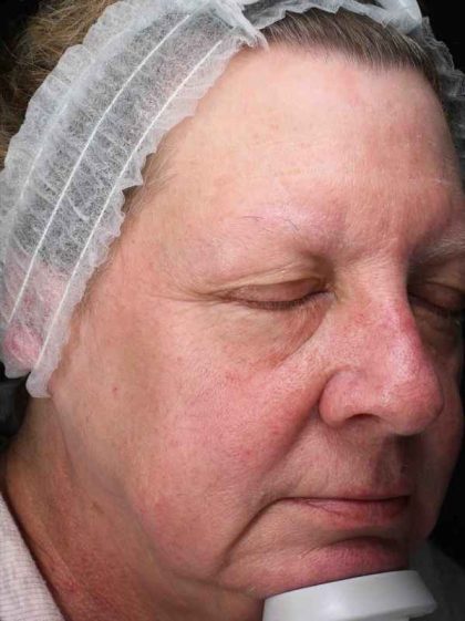Laser Resurfacing Before & After Patient #11182