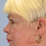 Laser Resurfacing Before & After Patient #11192