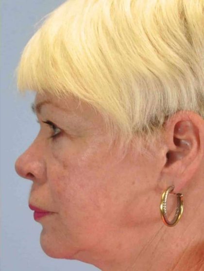 Laser Resurfacing Before & After Patient #11192