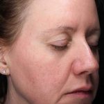 Laser Resurfacing Before & After Patient #11197