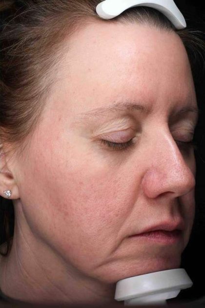 Laser Resurfacing Before & After Patient #11197