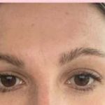 Laser Resurfacing Before & After Patient #11203