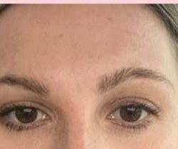 Laser Resurfacing Before & After Patient #11203
