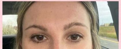 Laser Resurfacing Before & After Patient #11203