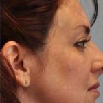 Laser Resurfacing Before & After Patient #11208