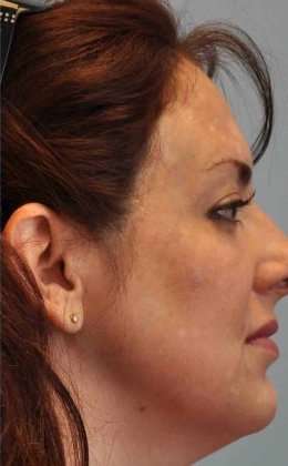 Laser Resurfacing Before & After Patient #11208