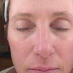 Laser Resurfacing Before & After Patient #11215