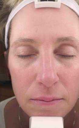 Laser Resurfacing Before & After Patient #11215