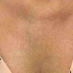 Laser Resurfacing Before & After Patient #11225