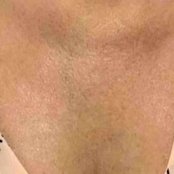 Laser Resurfacing Before & After Patient #11225