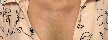 Laser Resurfacing Before & After Patient #11225