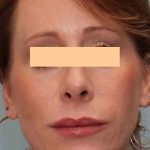Laser Resurfacing Before & After Patient #11228