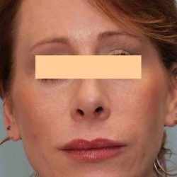 Laser Resurfacing Before & After Patient #11228
