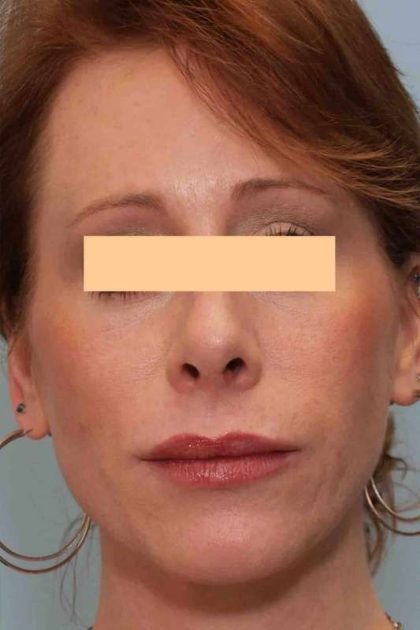 Laser Resurfacing Before & After Patient #11228