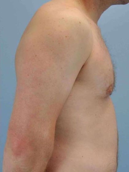 Gynecomastia Before & After Patient #11260