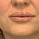 Fillers Before & After Patient #11263