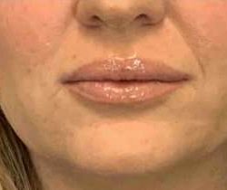 Fillers Before & After Patient #11263