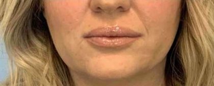 Fillers Before & After Patient #11263