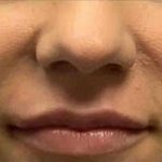 Fillers Before & After Patient #11266