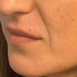 Fillers Before & After Patient #11269