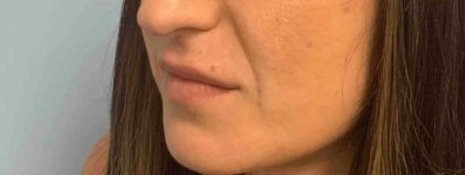 Fillers Before & After Patient #11269