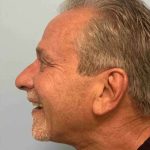 Fillers Before & After Patient #11276
