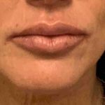 Fillers Before & After Patient #11283