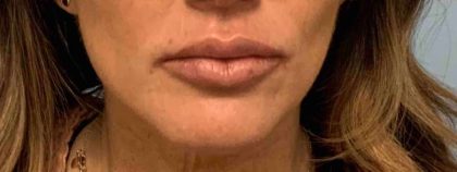 Fillers Before & After Patient #11283