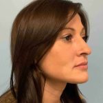 Fillers Before & After Patient #11288