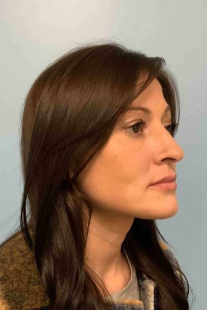 Fillers Before & After Patient #11288