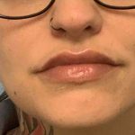 Fillers Before & After Patient #11291