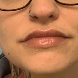 Fillers Before & After Patient #11291