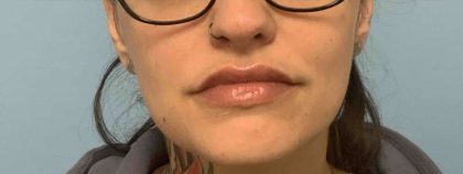 Fillers Before & After Patient #11291