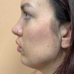 Fillers Before & After Patient #11298